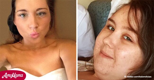 Une jeune femme atteinte de cancer affirme avoir été laissée par son petit ami parce qu'elle a pris du poids