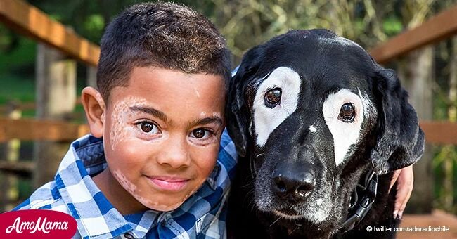 Un chien a aidé un petit garçon atteint de vitiligo à se regarder dans le miroir et à se sentir normal