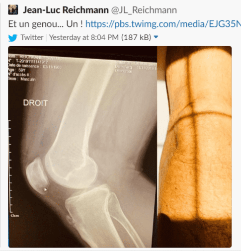 La jambe blessée de Jean-Luc Reichmann montrée en photo | Photo : Twitter 