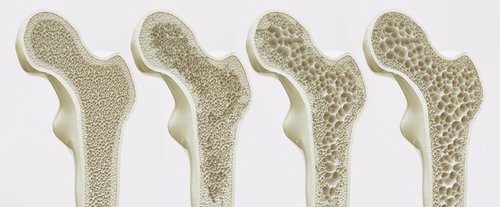 Ostéoporose | photo: shutterstock