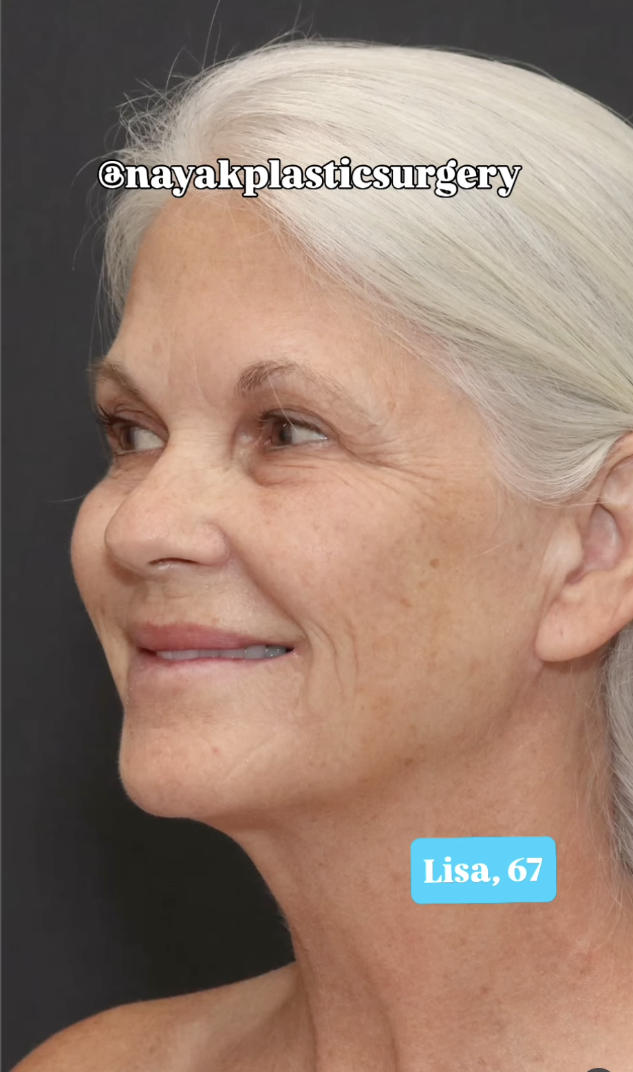 Lisa avant l'opération, comme on peut le voir dans un post daté du 1er juin 2025 | Source : Instagram/nayakplasticsurgery