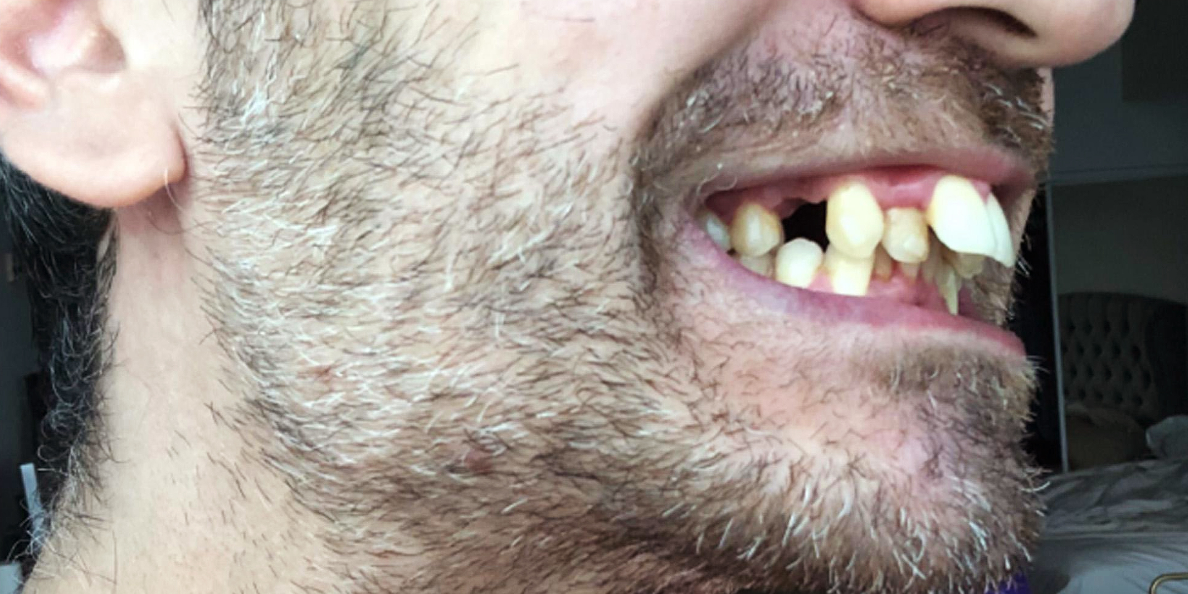L'utilisateur de Reddit @obvnotlupus montre son occlusion dentaire | Source : reddit.com/Damnthatsinteresting