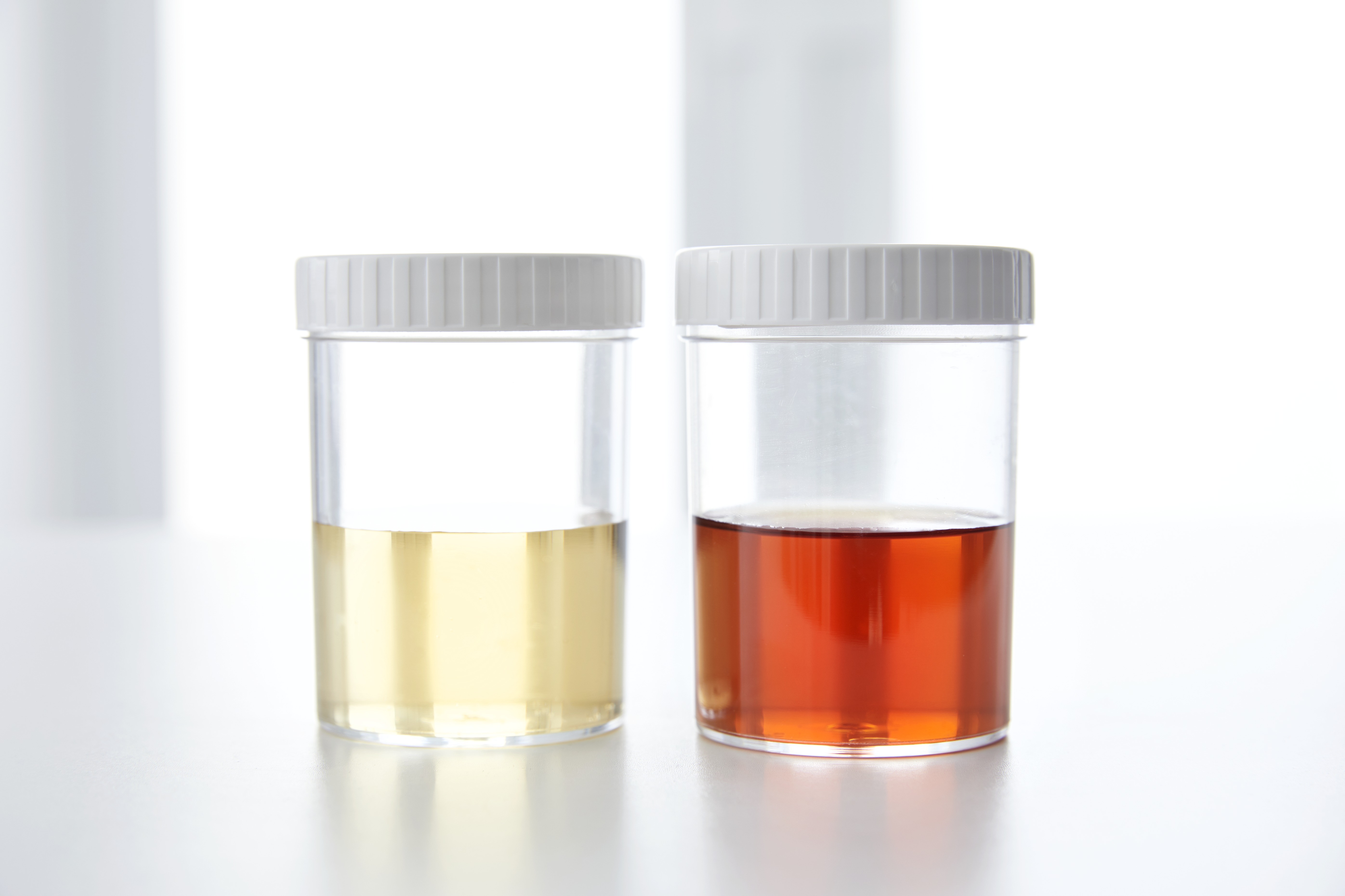Sang dans l'urine humaine dans un pot d'échantillonnage | Source : Getty Images