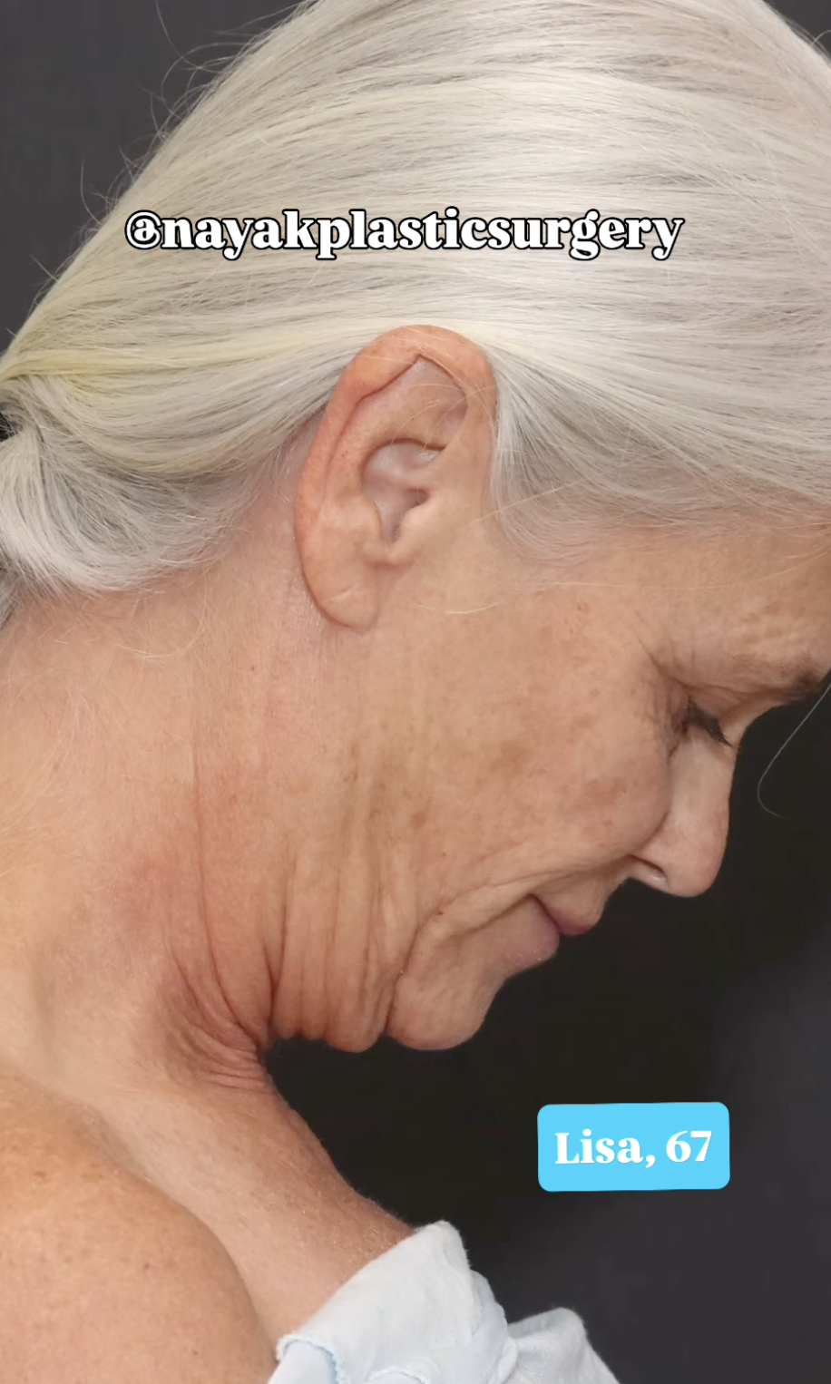 Lisa avant les interventions, en date du 1er juin 2025 | Source : Instagram/nayakplasticsurgery
