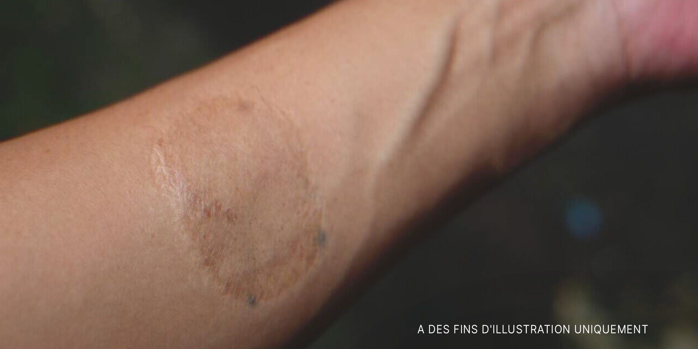 Une cicatrice sur le bras d'une femme. | Source : Shutterstock
